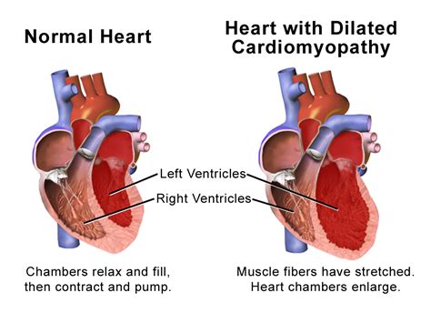 Gedilateerde Cardiomyopathie (DCMP) .